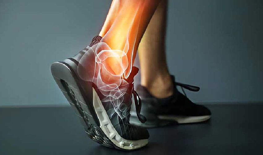 Ayak Bileği Kireçlenmesi: Nedenleri, Belirtileri ve Tedavi Yöntemleri