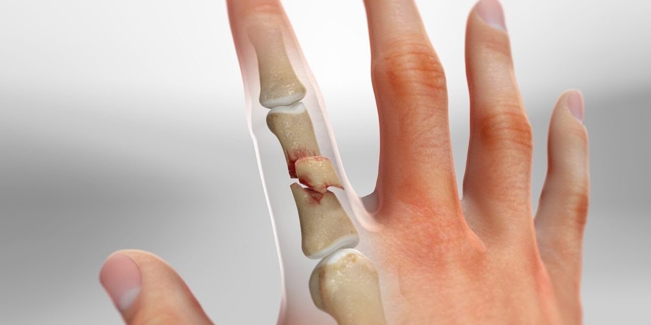 Falanks Kırığı: El ve Ayak Parmak Kırıklarında Tedavisi